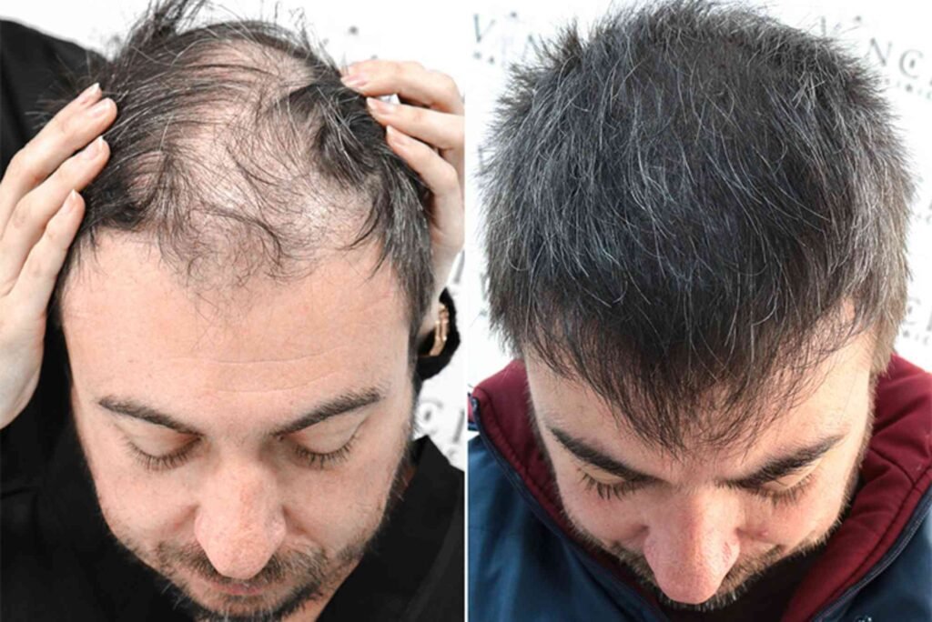 Best Hair Transplat Turkey